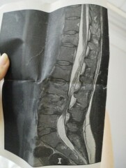 Spinal Fracture - Second Opinion - Medical Advice