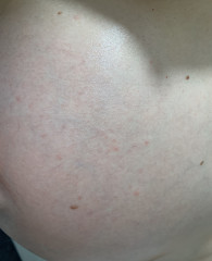 Red spots on bump- not itchy 