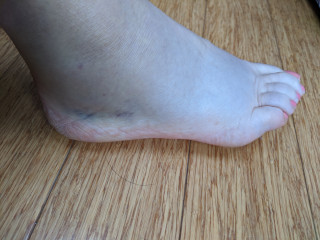 AIBU to think that this is just a sprain?