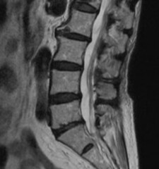Spinal Fracture - Second Opinion - Medical Advice