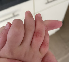 20 month old fell on dirty car park ground and grazed fingers 