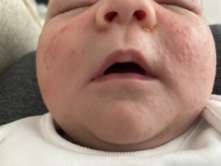 When did your babys newborn rash/baby acne clear up?