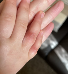 20 month old fell on dirty car park ground and grazed fingers 