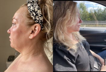 Would you have a face lift?