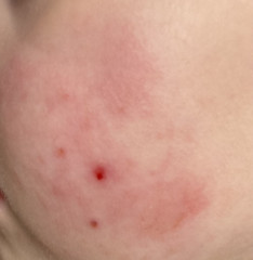 Possible allergy in 3 year old?