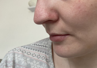 How to get rid of this awful nose
