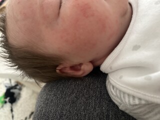 When did your babys newborn rash/baby acne clear up?