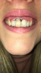 Teeth whitening £450/500 at dentist - alternatives?