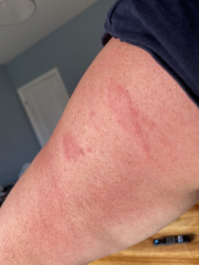Would you see someone about these bites?