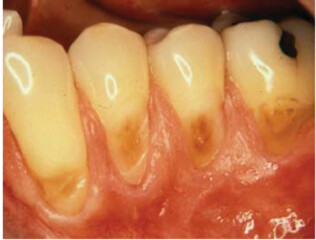 Teeth whitening £450/500 at dentist - alternatives?