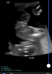 Advice please, Anatomy scan Boy or girl? Should I do a gender scan too? 