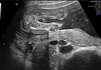 Gender scan at 18 weeks