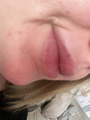 Red spot on lip that won't go away - any ideas?