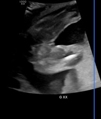 Advice please, Anatomy scan Boy or girl? Should I do a gender scan too? 