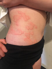 13 year old with severe hives