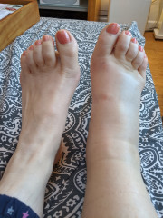 AIBU to think that this is just a sprain?