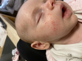 Baby acne? Mucus poo? Normal or cmpa? 