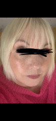 Micro needling - anyone had it done?