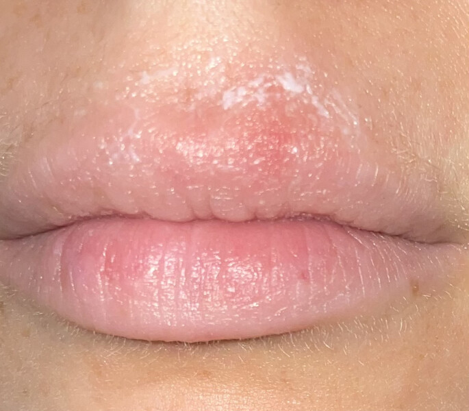 I've got my first cold sore ever and I'm about to get married
