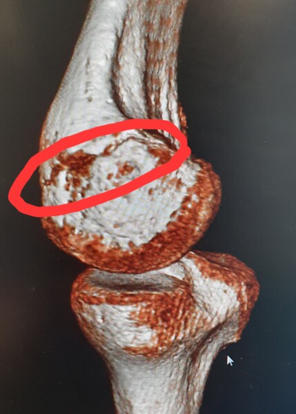 Anyone had a very very slow healing fracture?