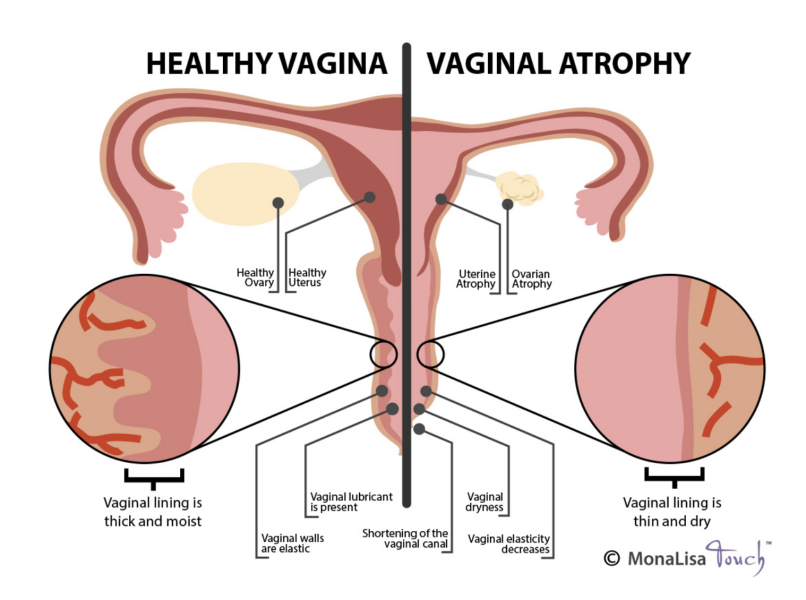 "Doctors warn against over-medicalising menopause"