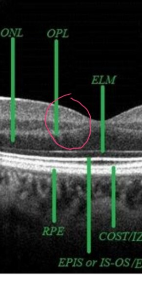 Anyone know about pre diabetes/ diabetes and sight loss?