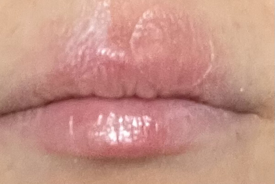 I've got my first cold sore ever and I'm about to get married