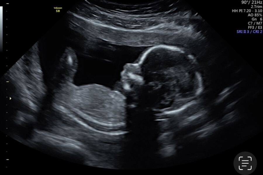 BFPs following IVF to take symptoms & scans