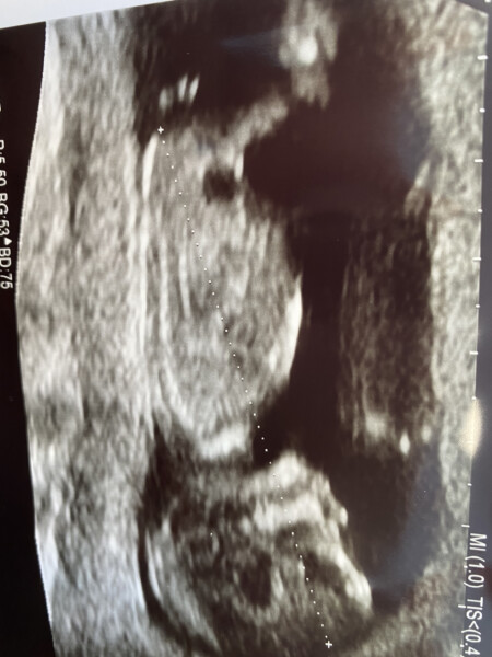 Navigating pregnancy after loss thread 3