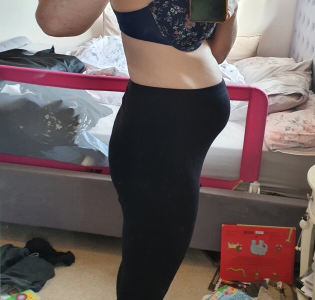 diasti recti repair NHS