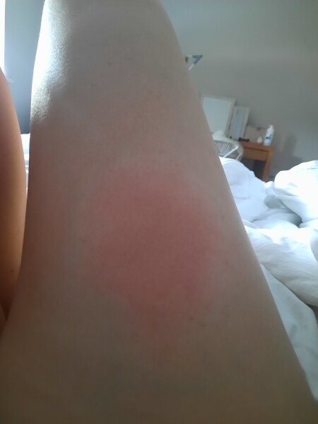 Does anyone self inject? Does this look OK?