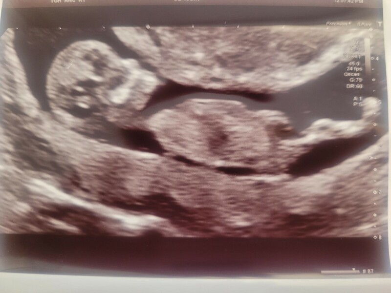 Pregnancy after miscarriage - thread 2