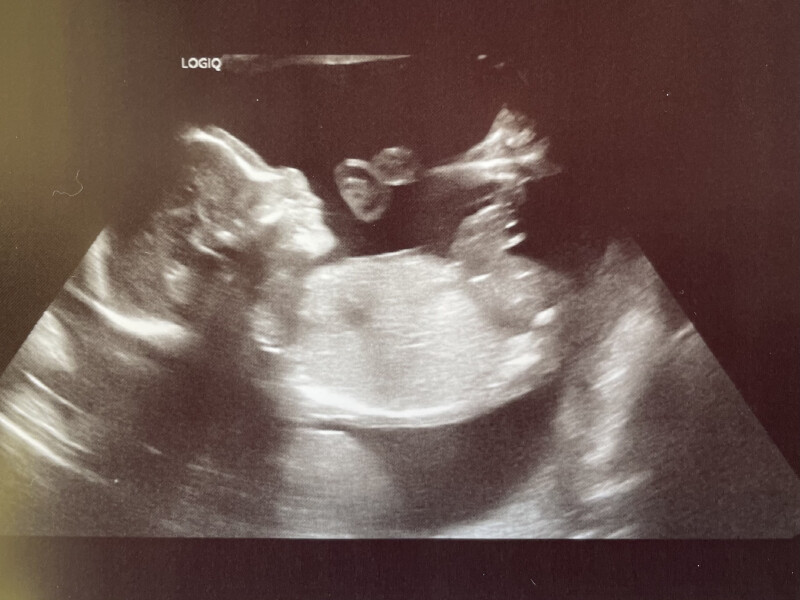 BFPs following IVF to take symptoms & scans