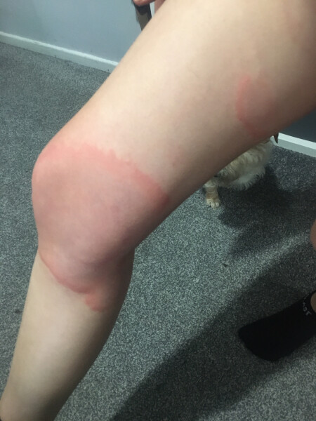 13 year old with severe hives