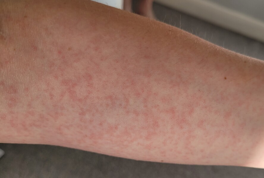 What's this rash?
