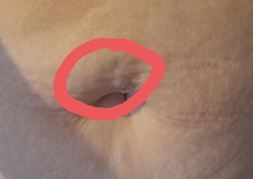 Lump/swelling above belly button area