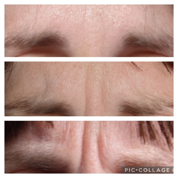 49 - is it worth getting botox? Is it too late?