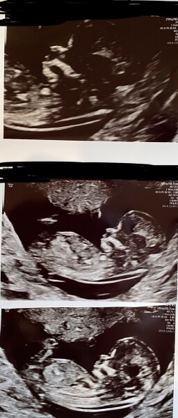 Nub guesses - boy or girl? 
