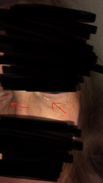 Small yellow bumps near eye - how to have removed?
