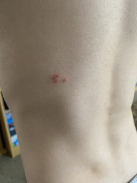 Maybe Bug bites? Really sore, picture attached 