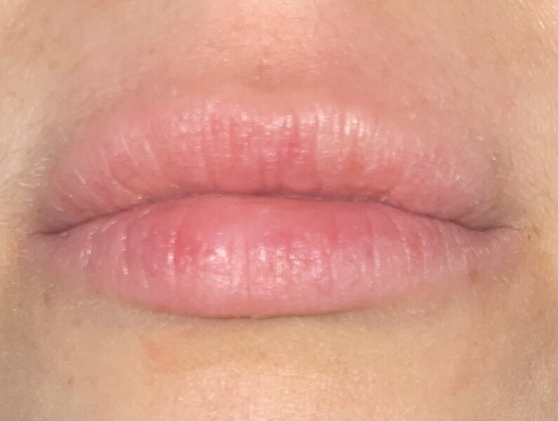 I've got my first cold sore ever and I'm about to get married