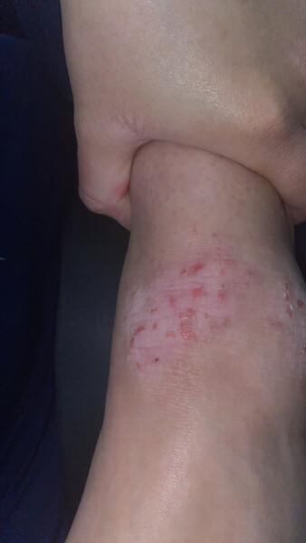 Anyone got any experience with Eczema?