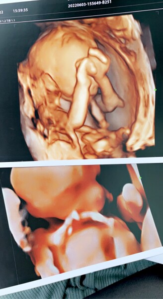 👶 Due November 2022 - part II 🎆