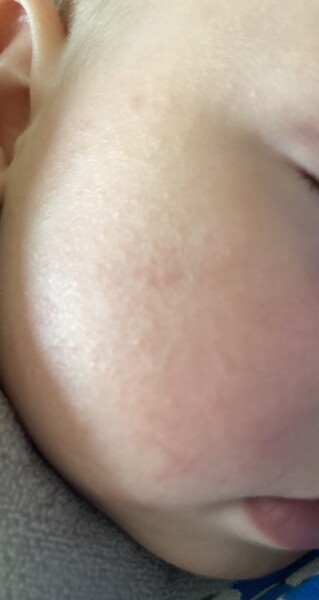Rash on baby skin (photo)