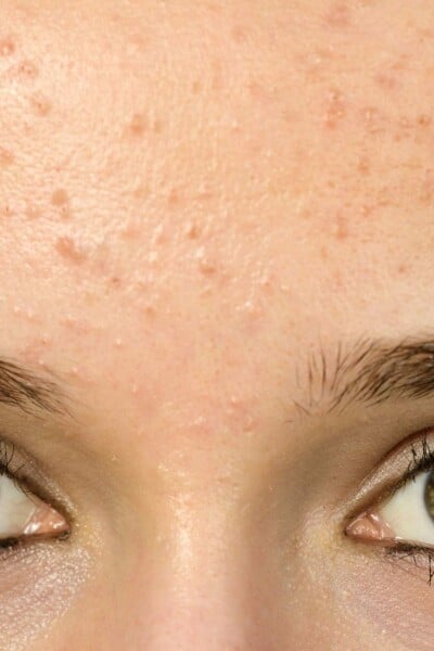 DD(11) t-zone pimples - best low effort approach to skincare? 