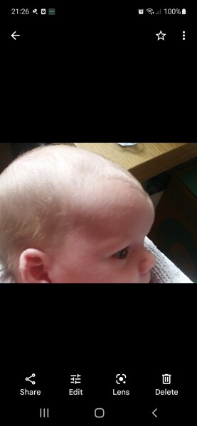 Baby abnormal head shape? - Thoughts please 