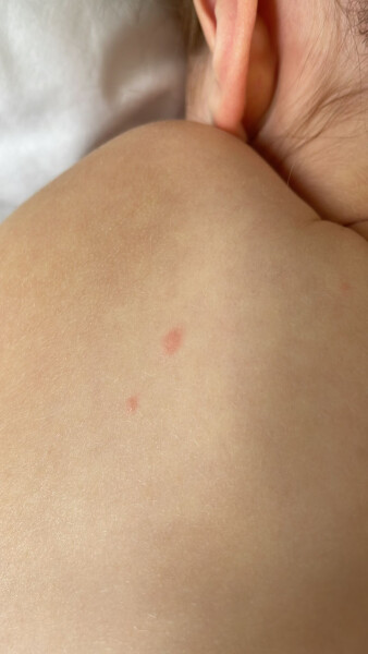 Chicken pox or bites? 
