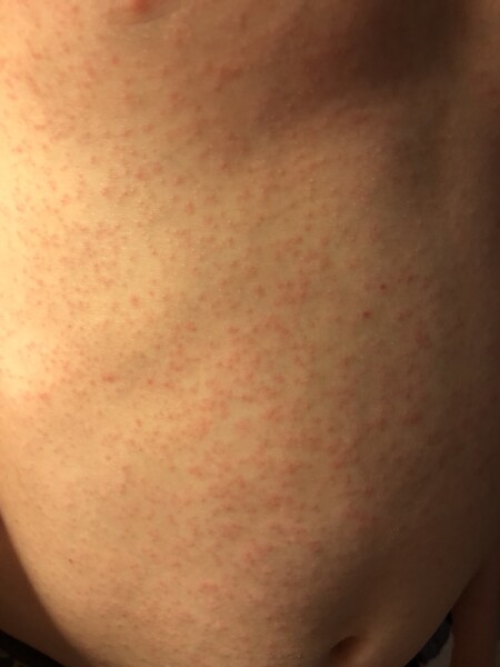 What is this rash?