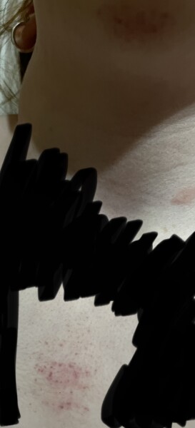 Pinpoint rash that looks like a bruise but dd swears she hasnt hurt it?