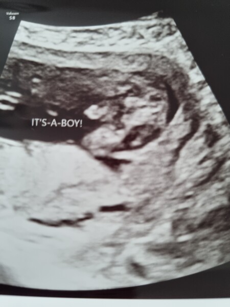 Ultrasound scan boy or cord?